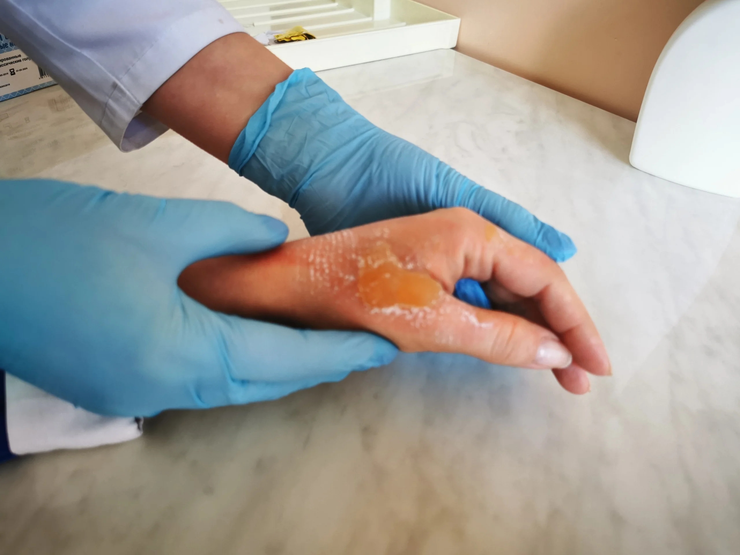 How To Know When to Hire a Burn Injury Lawyer