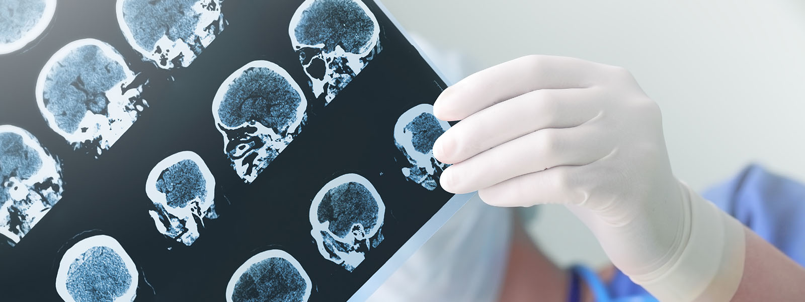 When to Hire an Attorney for a Brain Injury