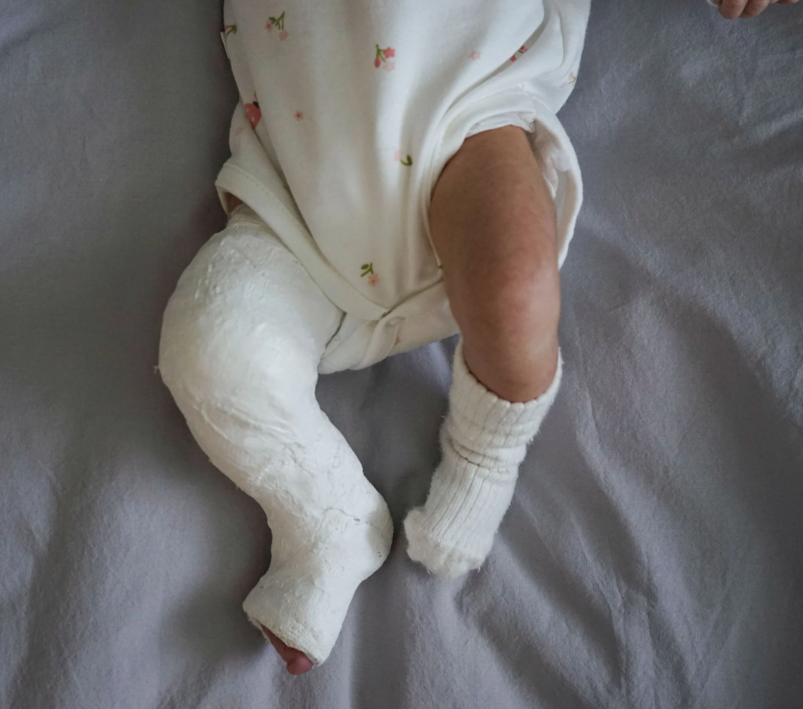 Baby Broken Bones